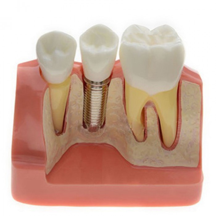 Dental Implant Demo Training Model for Students Patients M2017