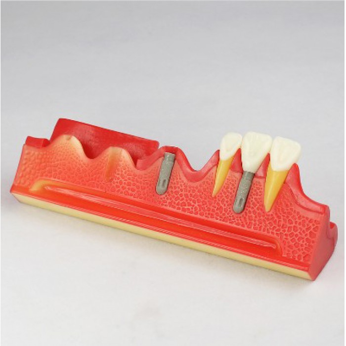 Dental Implant Demonstration Model for Patient Education M2018