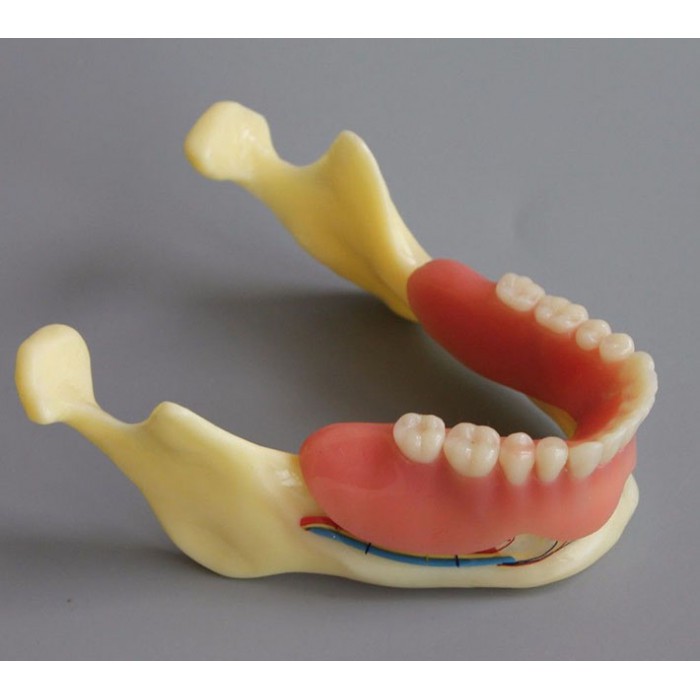 Dental Implant Overdenture Model for Study Training Demonstration #2014 02