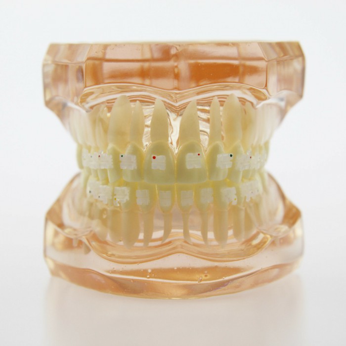 Dental Orthodontic Model with Metal Ceramic Brackets Demo Study Model 3002