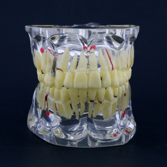 Dental Study Model Adult Pathology Typodont Teeth Teaching Model #4001