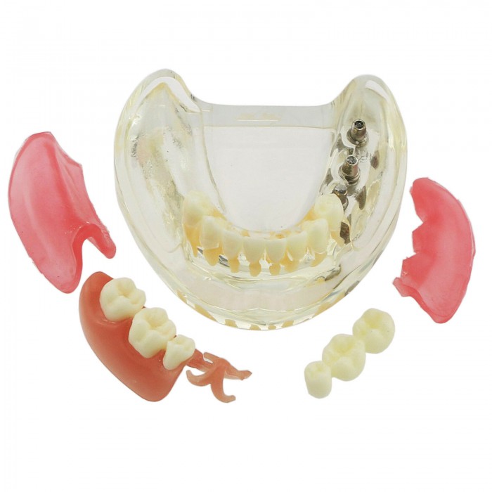 Dental Teeth Implant Model with Removable Bridge Demo Model 6006