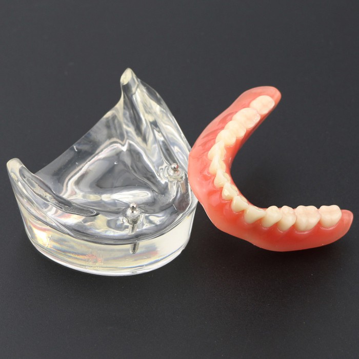 Dental Teeth Implant Overdenture Model Lower Jaw with 2 Implants Education Study Demo Model 6002 01