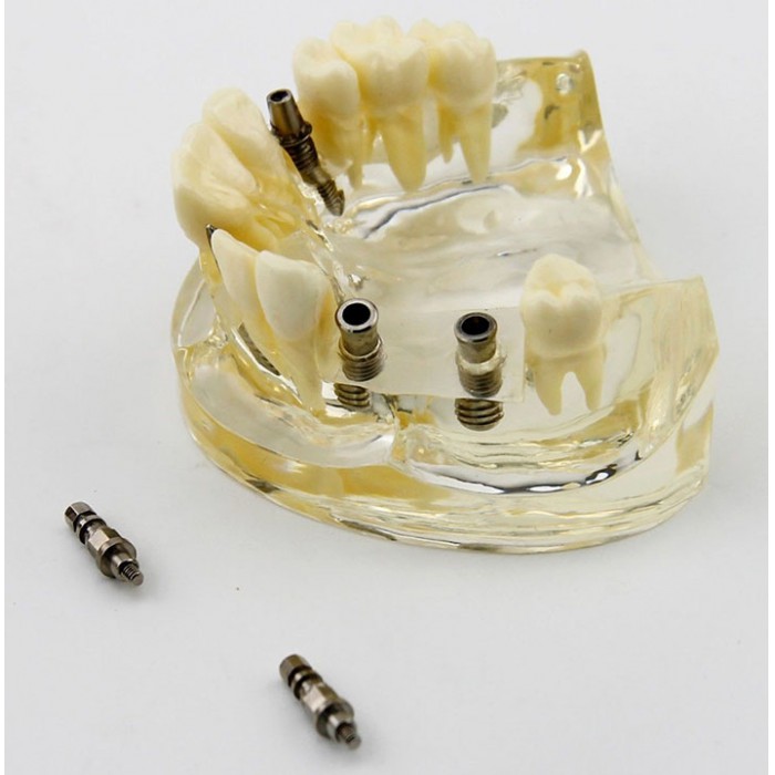 Dental Upper Jaw Implant Study Model Teaching Training Demostration 2005