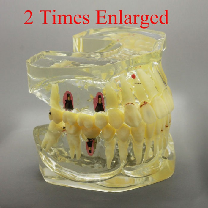 2 Times Enlarged Dental Implant Study Training Demo Model with Bridge