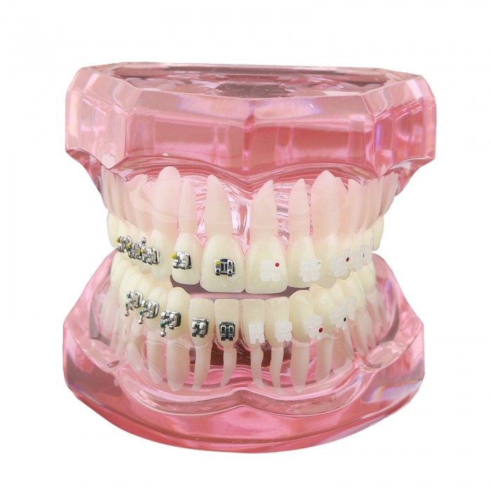 Orthodontic Teeth Model with Metal and Ceramic Bracket Braces Dental Study Training Model 3003