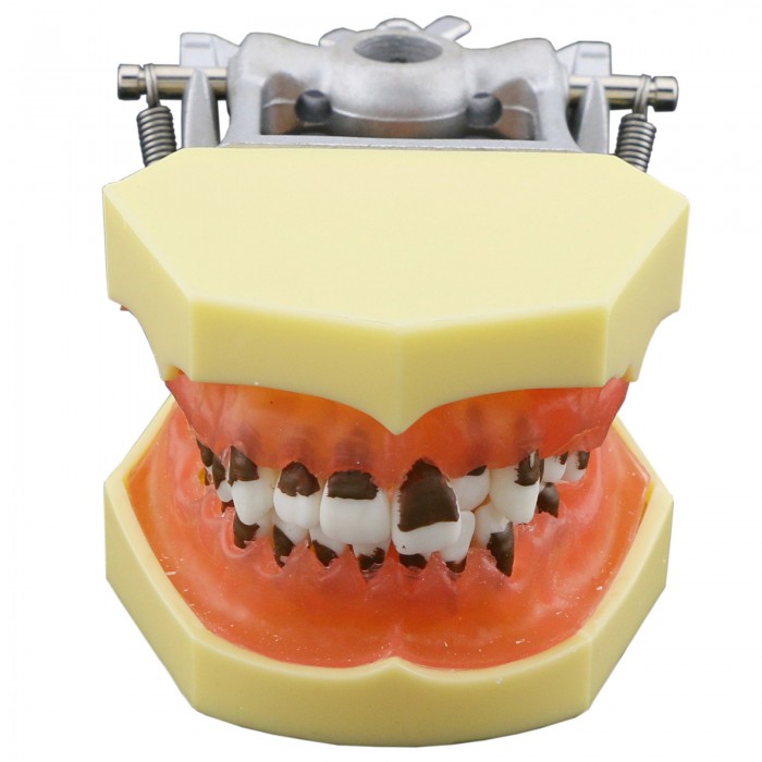 Teeth Periodontal Model Demonstration Training Study Model Inflamed Gingivae Calculs 4003