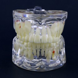 Dental Children Pediatric Pathology Demonstration Education Study Teeth Model 4002