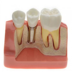 Dental Implant Demo Training Model for Students Patients M2017