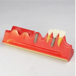 Dental Implant Demonstration Model for Patient Education M2018