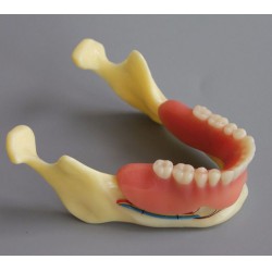 Dental Implant Overdenture Model for Study Training Demonstration #2014 02