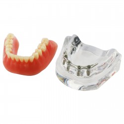 Dental Implant Overdenture Model Lower Jaw with 4 Implants Silver Bar
