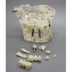 Dental Implant Study Demonstration Teeth Disease Model with Restoration for Students