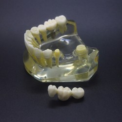 Dental Implant Study Training Demo Model Lower Jaw Crown Bridge 2010