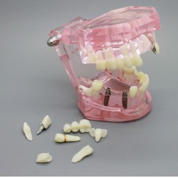 Dental Implant Teeth Model for Study Demonstration with Restoration 2001 Pink