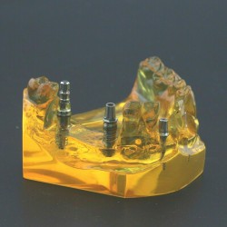 Dental Implant Typodont Teeth Model Upper Jaw Demo Model #201102