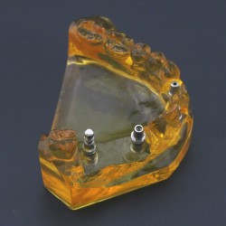 Dental Implant Typodont Teeth Model Upper Jaw Demo Model #201102