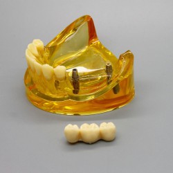 Dental Lower Jaw Implant Model with 2 Implants and Fixed Bridge 2011