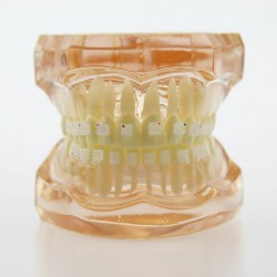 Dental Orthodontic Model with Metal Ceramic Brackets Demo Study Model 3002