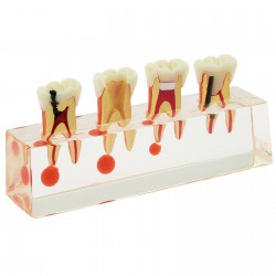 Dental Teeth Anatomical Model 4-Stage Endodontic Treatment Study Traning Model 4018 01
