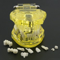 Dental Teeth Implant Model for Training Teaching Patient Education 2001 Yellow