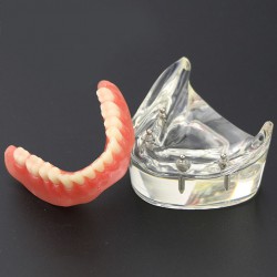 Dental Teeth Implant Overdenture Model Demo Study 6002 02 Lower Jaw 4 Implants