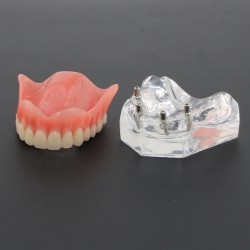 Dental Teeth Implant Overdenture Model Upper Jaw With 4 Implants Study Demo Model 6001