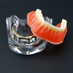 Dental Teeth Overdenture Implant Model Lower Jaw 4 Implant Golden 6009