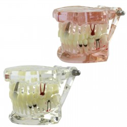 Dental Teething Implant and Restoration Model Implant Demo Caries Model