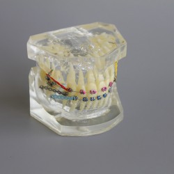Dental Typodont Model Orthodontic Demonstration Practice Model With Metal Bracket Archwire