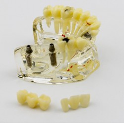 Dental Upper Jaw Implant Model with Bridge and Caries Demo Study 2006