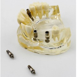 Dental Upper Jaw Implant Study Model Teaching Training Demostration 2005