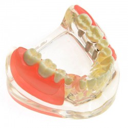 M-6006 Dental Study Training Model Contrast Implant Restoration for Missing Molar Teeth