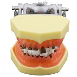 Teeth Periodontal Model Demonstration Training Study Model Inflamed Gingivae Calculs 4003