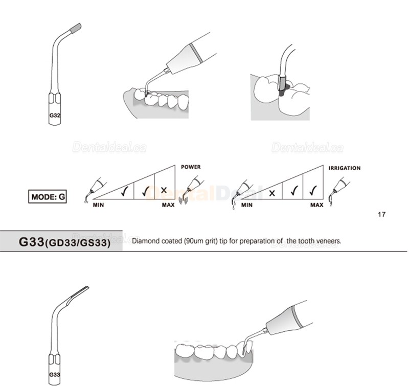 5Pcs Refine&reg; Ultrasonic Piezo Restorative Tips G20 G21 G30 G31 G32 G33 G35 Fit EMS Woodpecker