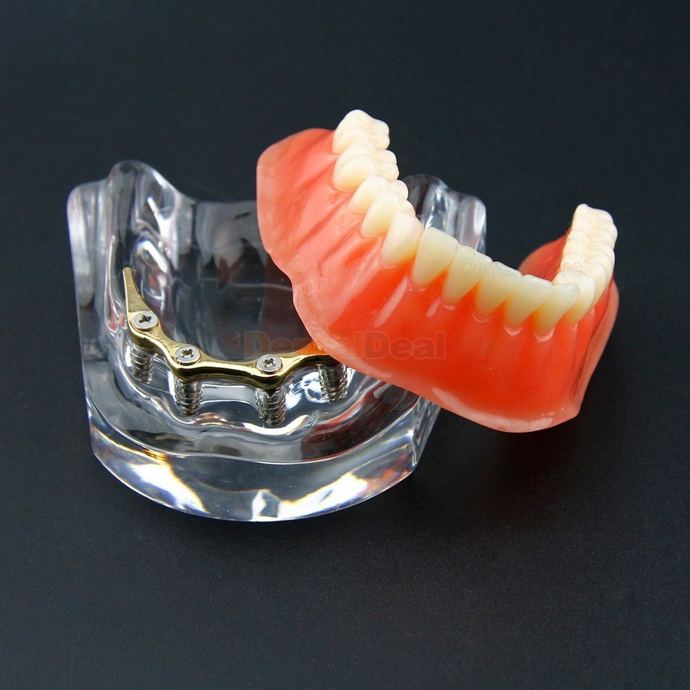 Dental Teeth Overdenture Implant Model Lower Jaw 4 Implant Golden 6009