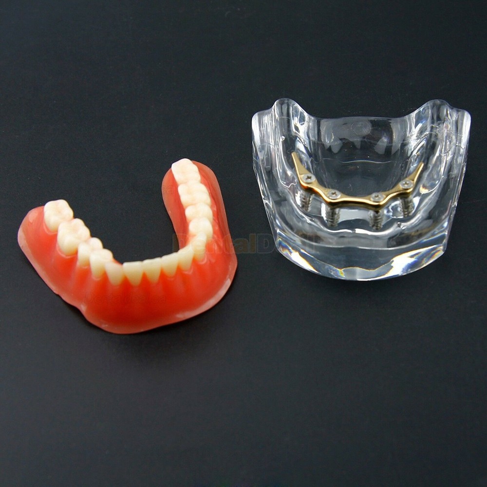 Dental Teeth Overdenture Implant Model Lower Jaw 4 Implant Golden 6009