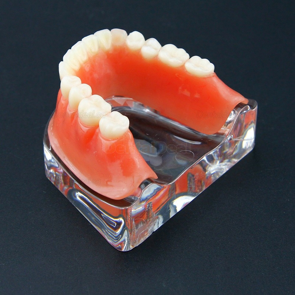 Dental Teeth Overdenture Implant Model Lower Jaw 4 Implant Golden 6009