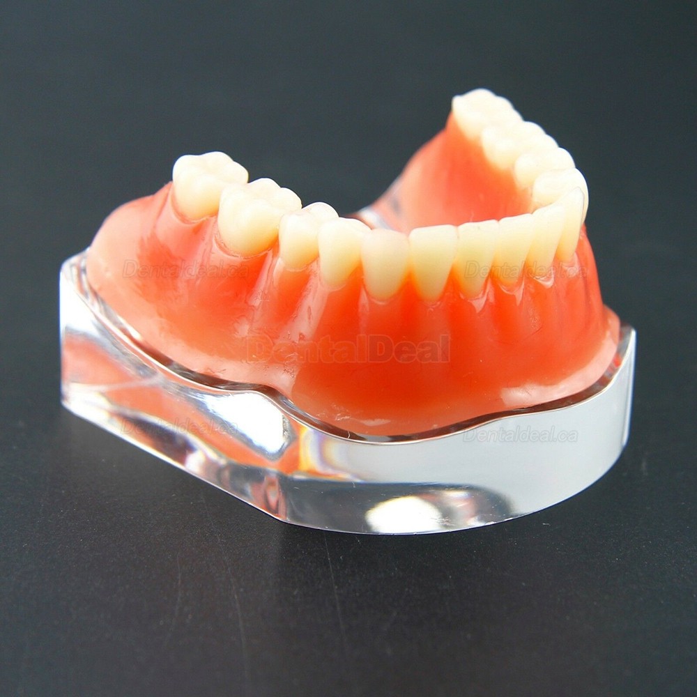 Dental Teeth Overdenture Implant Model Lower Jaw 4 Implant Golden 6009