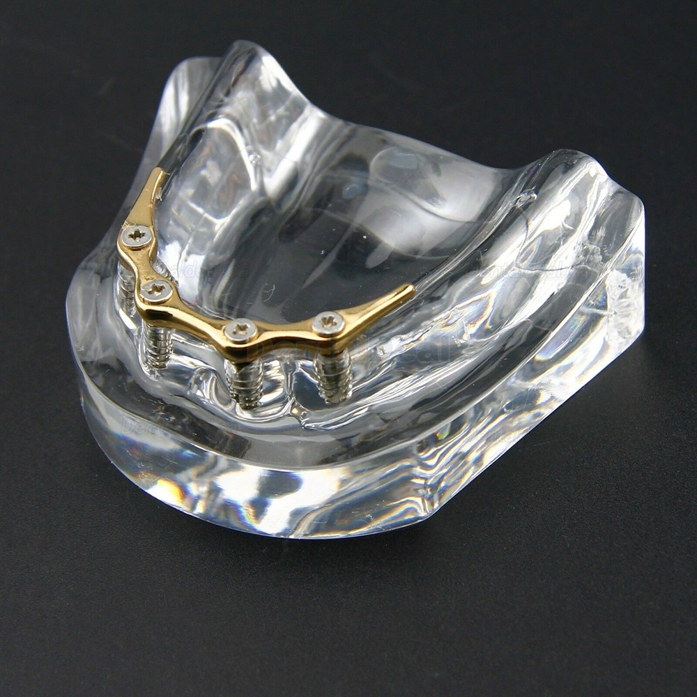 Dental Teeth Overdenture Implant Model Lower Jaw 4 Implant Golden 6009