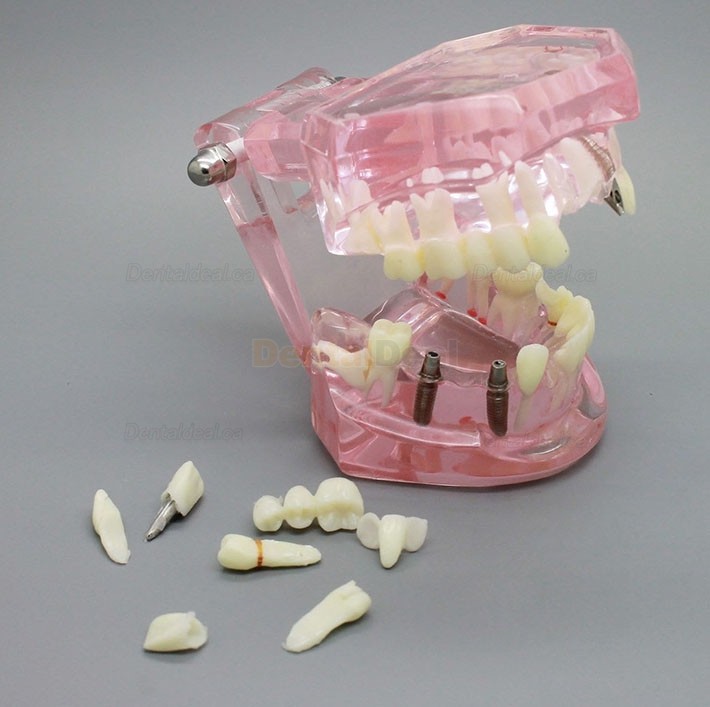 Dental Implant Teeth Model for Study Demonstration with Restoration 2001 Pink