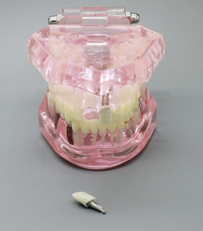 Dental Implant Teeth Model for Study Demonstration with Restoration 2001 Pink