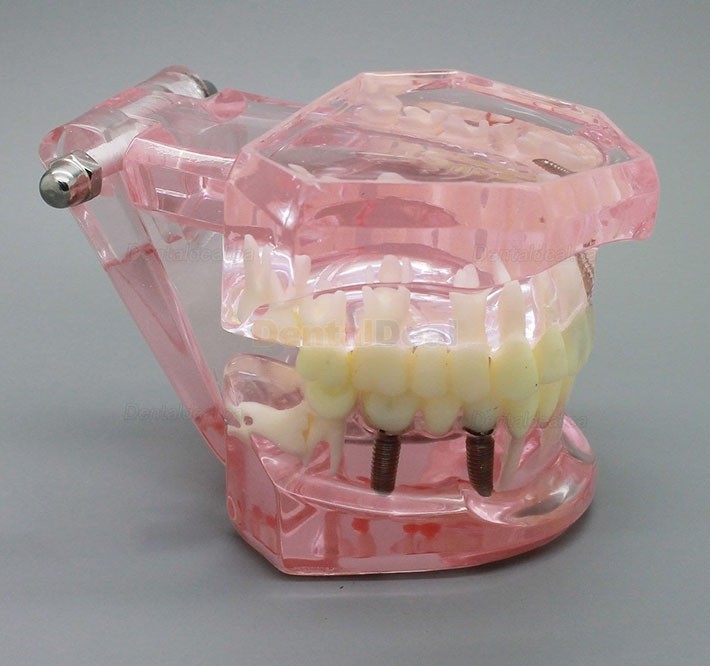 Dental Implant Teeth Model for Study Demonstration with Restoration 2001 Pink