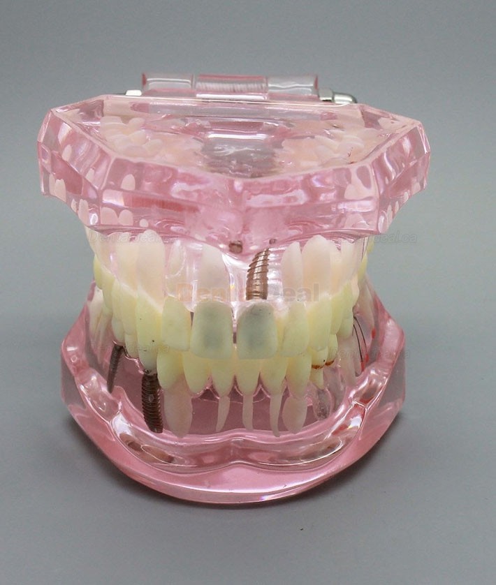 Dental Implant Teeth Model for Study Demonstration with Restoration 2001 Pink