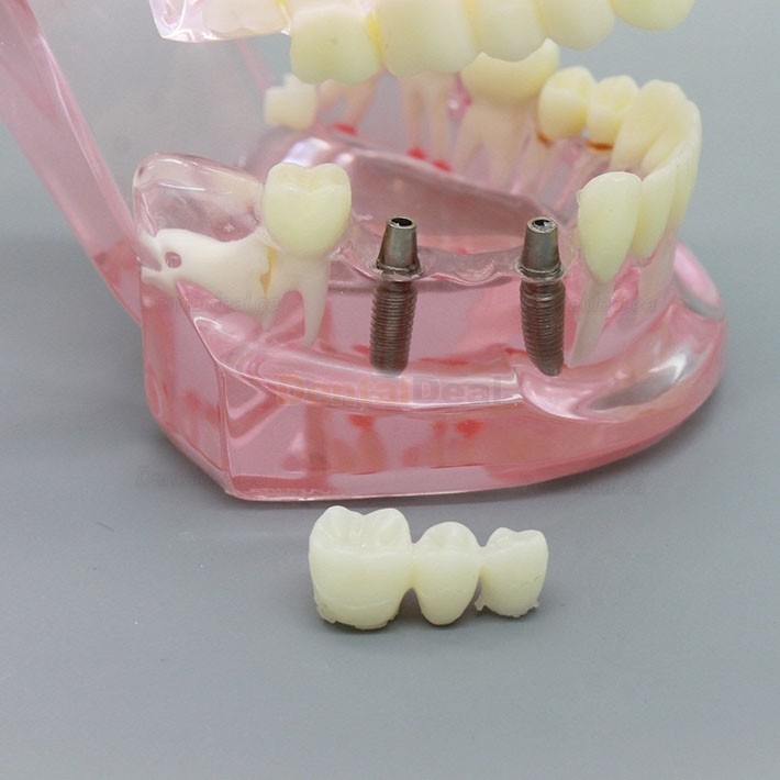 Dental Implant Teeth Model for Study Demonstration with Restoration 2001 Pink