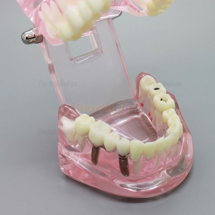 Dental Implant Teeth Model for Study Demonstration with Restoration 2001 Pink