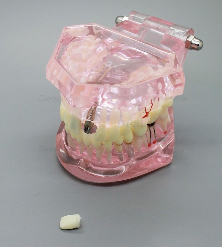 Dental Implant Teeth Model for Study Demonstration with Restoration 2001 Pink
