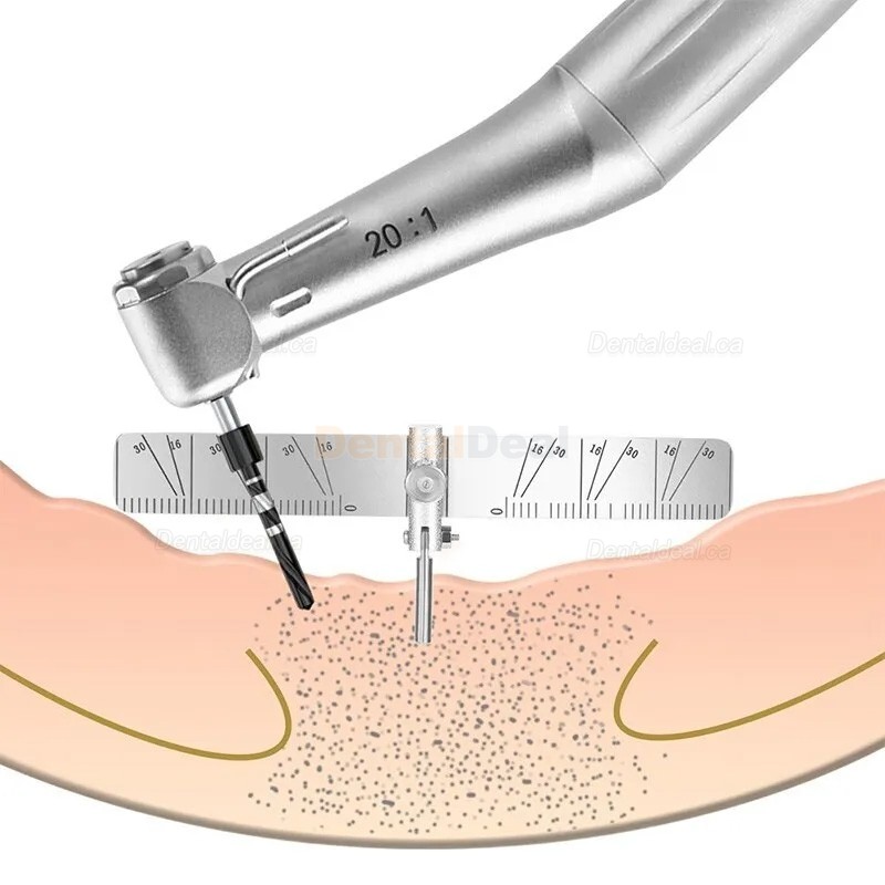 Dental Implant Surgical Guide Bendable Implant Locating Guide Angle Ruler