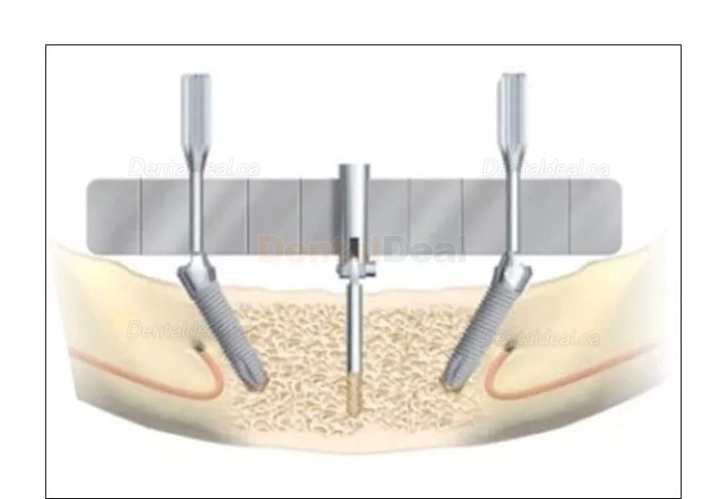 Dental Implant Surgical Guide Bendable Implant Locating Guide Angle Ruler