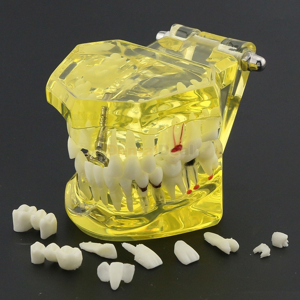 Dental Teeth Implant Model for Training Teaching Patient Education 2001 Yellow